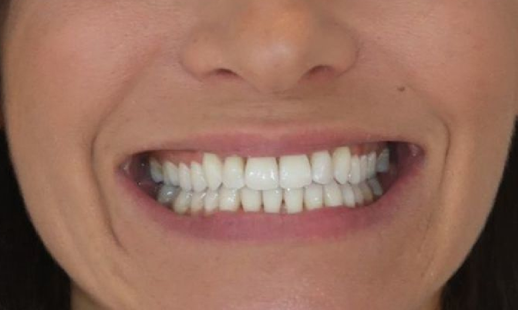 before-after