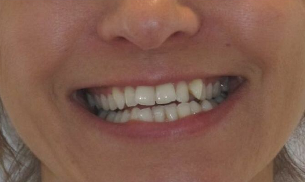 before-after