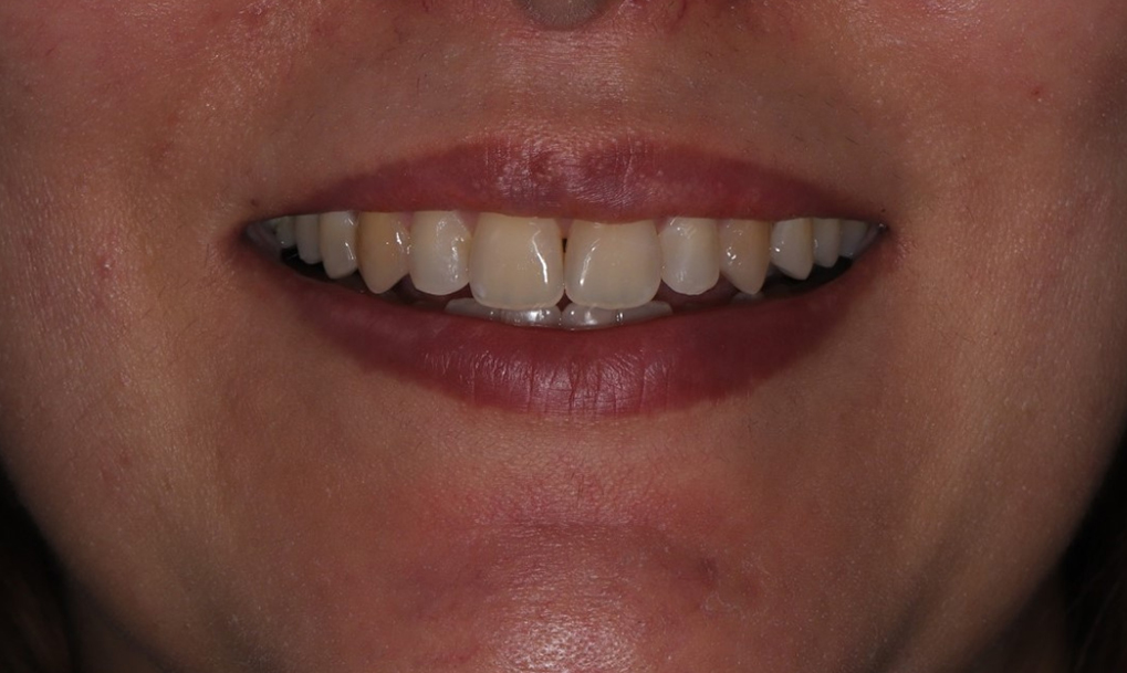 before-after