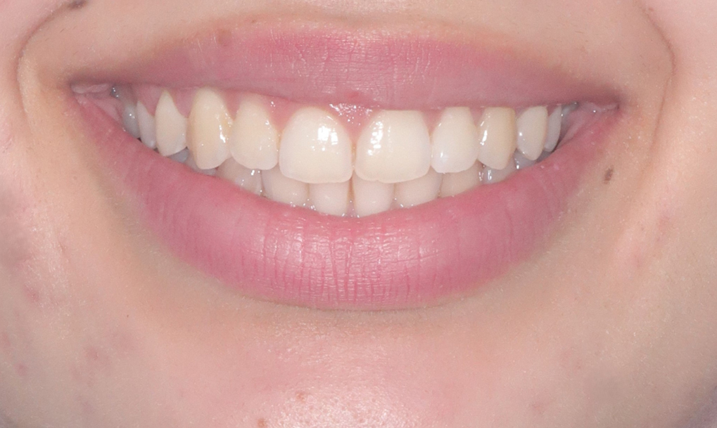 before-after