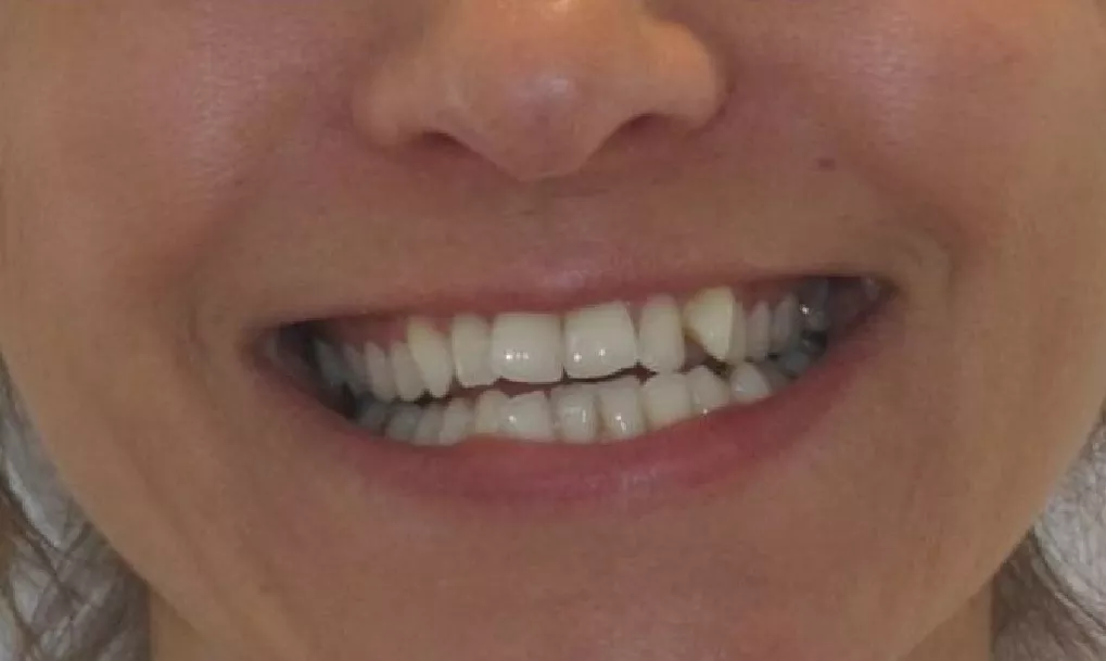 before-after