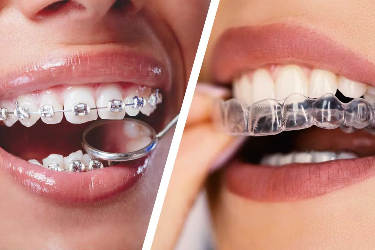 Appareils dentaires invisibles (Clear Aligners) vs Appareils traditionnels : quel est le meilleur choix pour vous à Casablanca ?